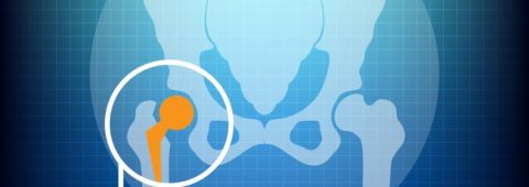 Artroplastie totala de sold