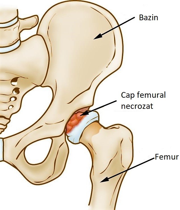 osteoartrita femurului osteocondroza coloanei vertebrale la adulți