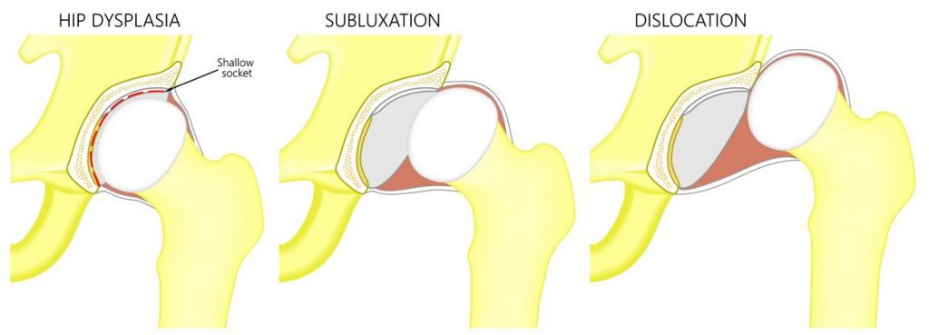 subluxarea bilaterală a tratamentului articulației șoldului)